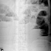 急性肠梗阻病人术前处理