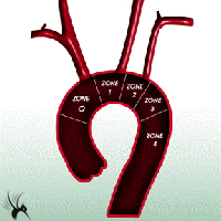 胸主动脉分区示意图